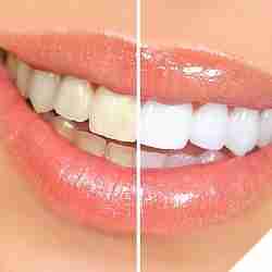 Teeth Whitening Kit Review Guide