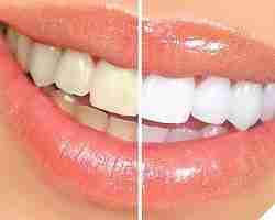 Teeth Whitening Kit Review Guide